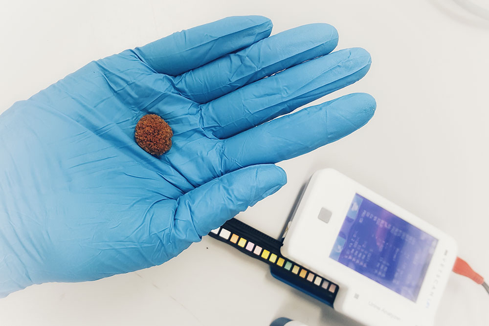 A gloved hand holds a small, brown, textured bladder stone next to a digital urine analyzer and a used diagnostic dipstick.
